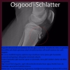 Osgood Schlatter Hastalığı