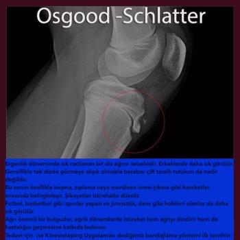 Osgood Schlatter Hastalığı